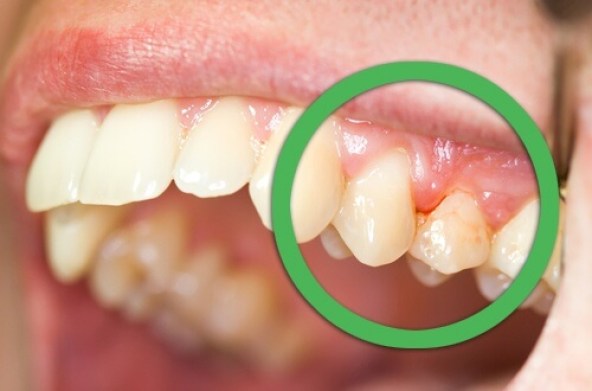 Upala zubnog mesa prirodni lijekovi koji stvarno djeluju?