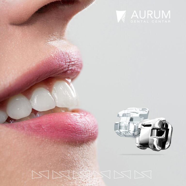 Damon ortodontski aparatići Aurum Dental Centar Banja Luka