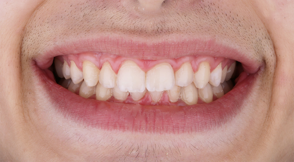 Ortodontski Aparat Za Zube Stomatoloska Ordinacija Banja Luka Ortodoncija Aurum Dental Centar 01