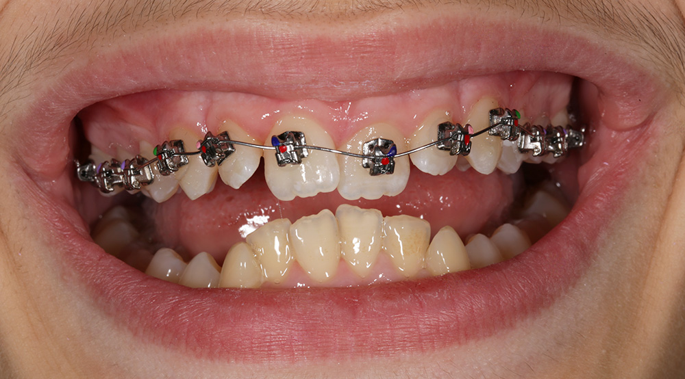 Ortodontski Aparat Za Zube Stomatoloska Ordinacija Banja Luka Ortodoncija Aurum Dental Centar 02