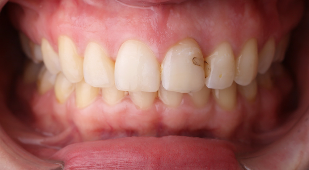 Slika3 Aurum Dental Centar Stomatoloska Ordinacija Banja Luka Izbjeljivanje Zuba Zubne Krune 2