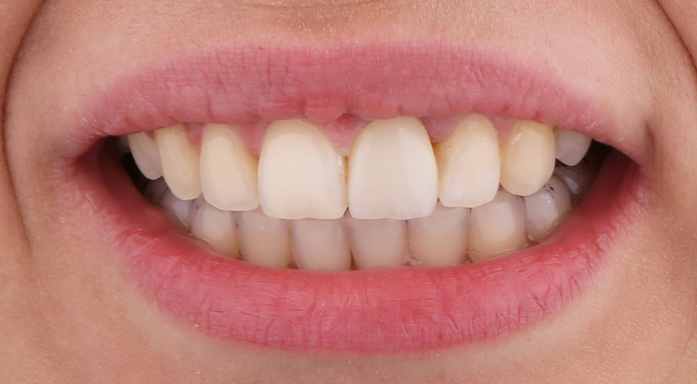 Slika3 Aurum Dental Centar Stomatoloska Ordinacija Banja Luka Izbjeljivanje Zuba Zubne Krune