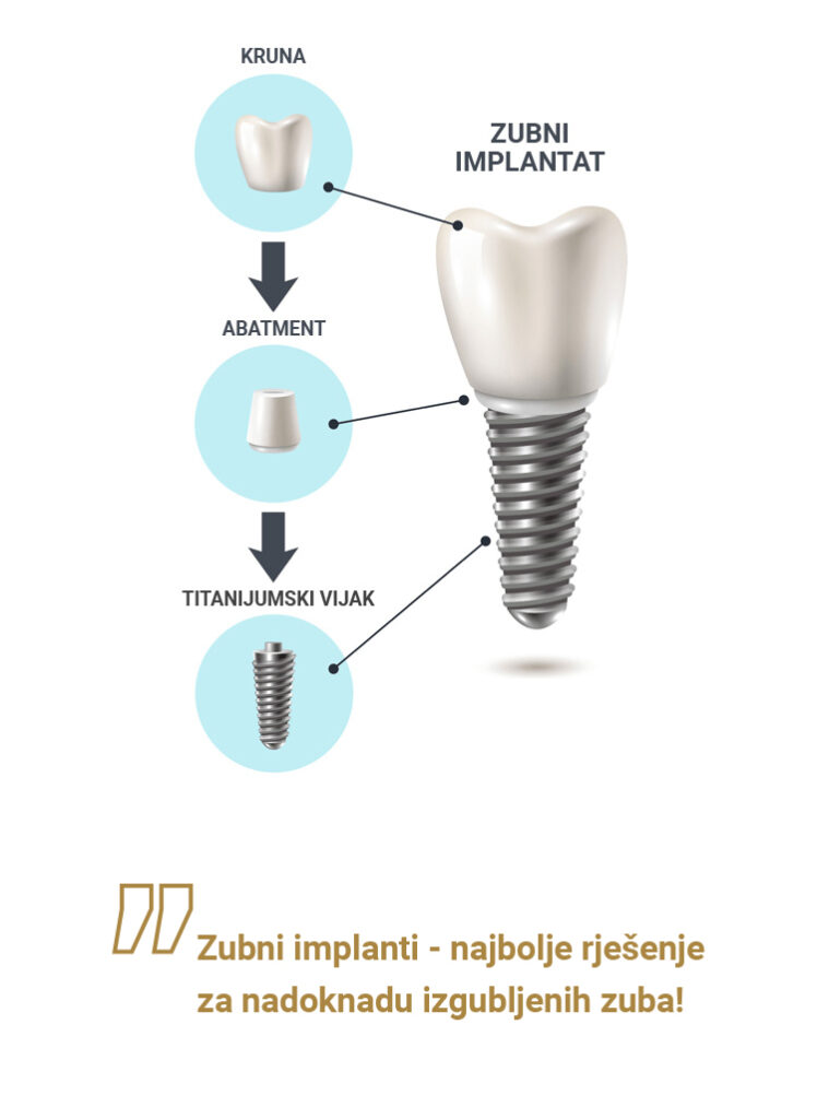 Zubni Implantat Zubar Banja Luka Straumann Implantati