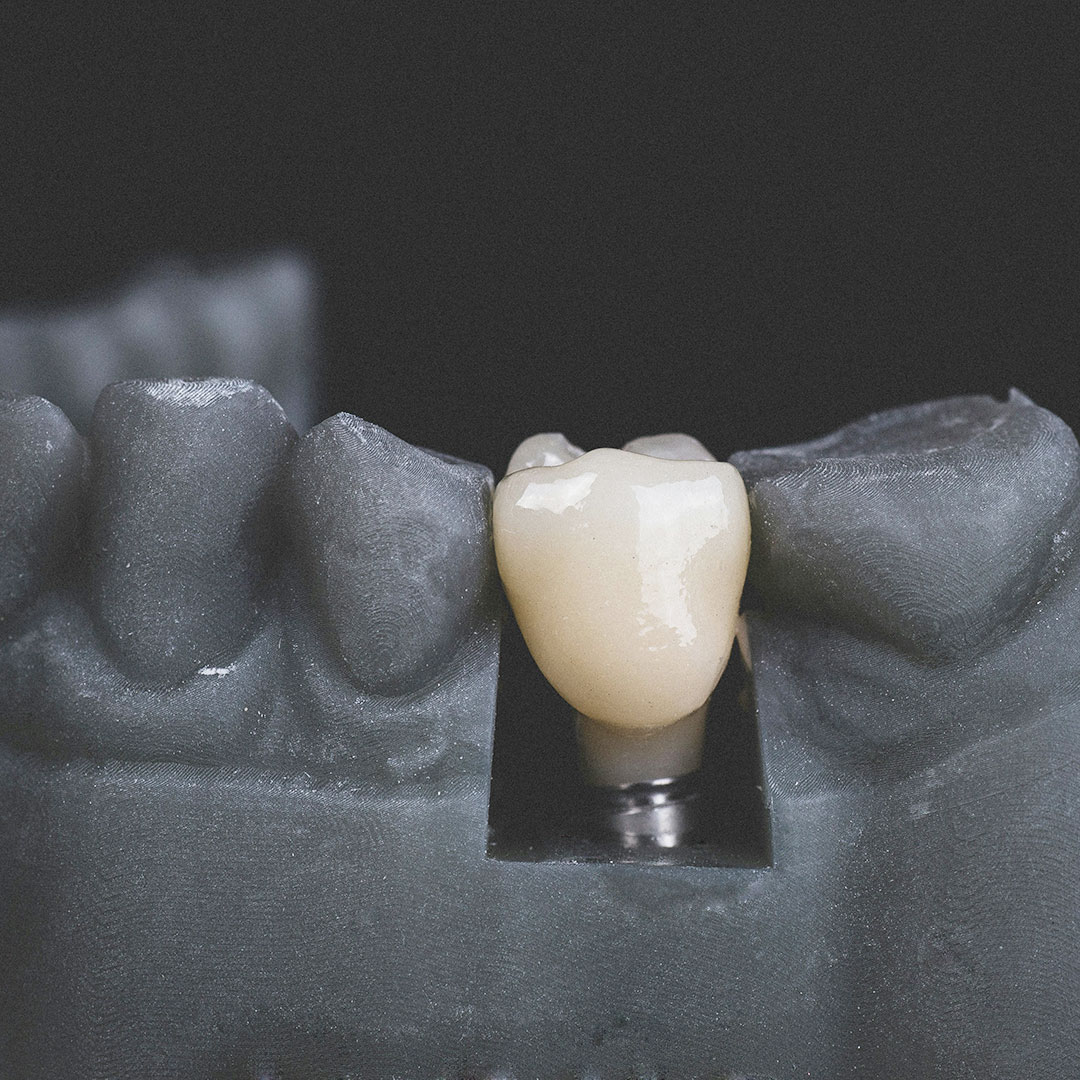 Cijena zubnog implantata?