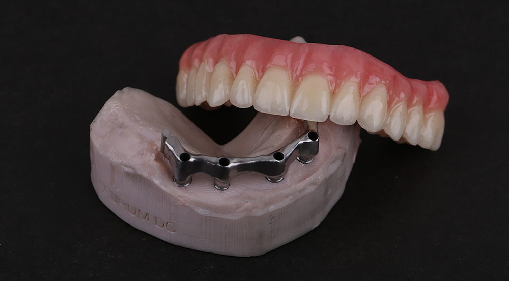 Zubna Proteza Na Implantatima Cijena Zubar Banja Luka Aurum Dental Centar
