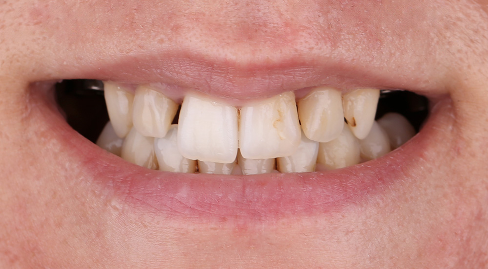 Zubni Implantati Cirkon Krune Aurum Dental Centar Stomatoloska Ordinacija Banja Luka 01