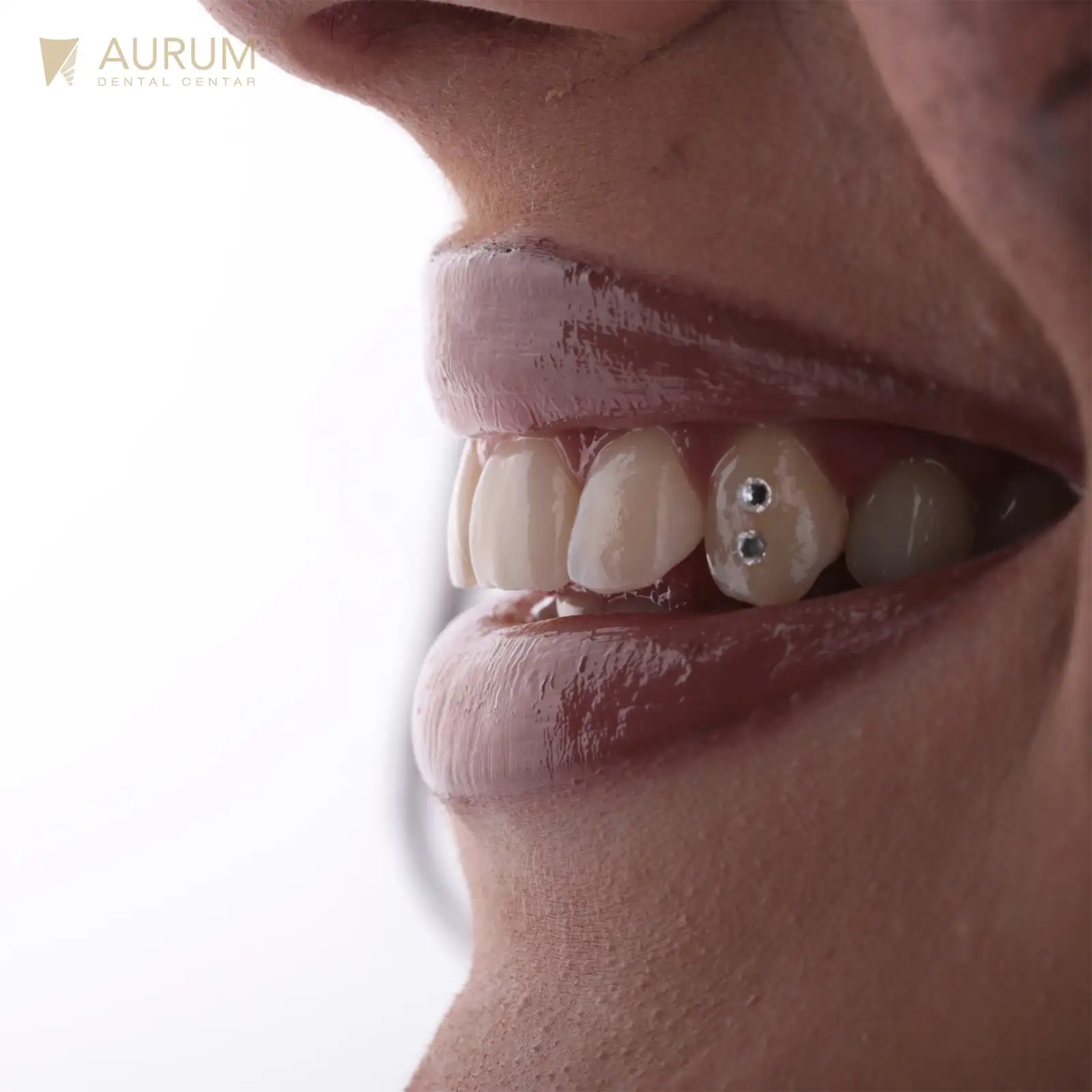 ZUBNI NAKIT. Cirkon na zubu.