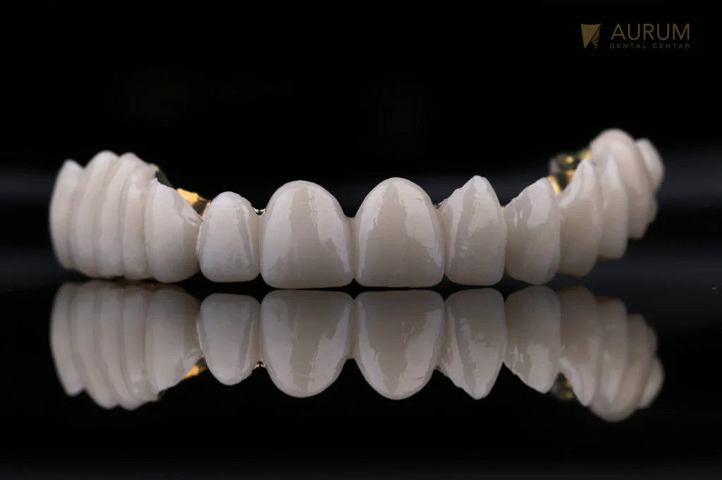 Cirkonski most sa titanijumskim ojačanjem u Aurum Dental Centru u Banja Luci