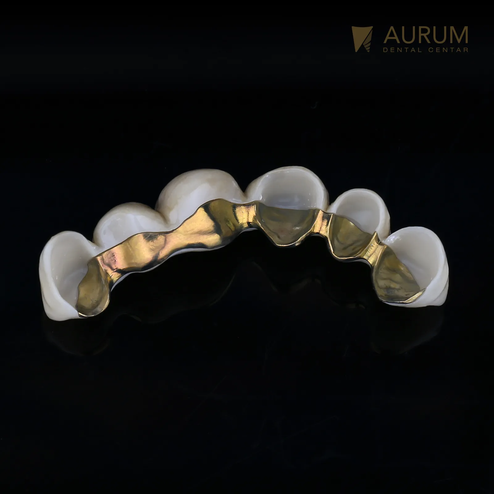 Cirkonski most sa titanijumskim ojačanjem (Ivoclar Prime Cirkon + Sheftner titan)