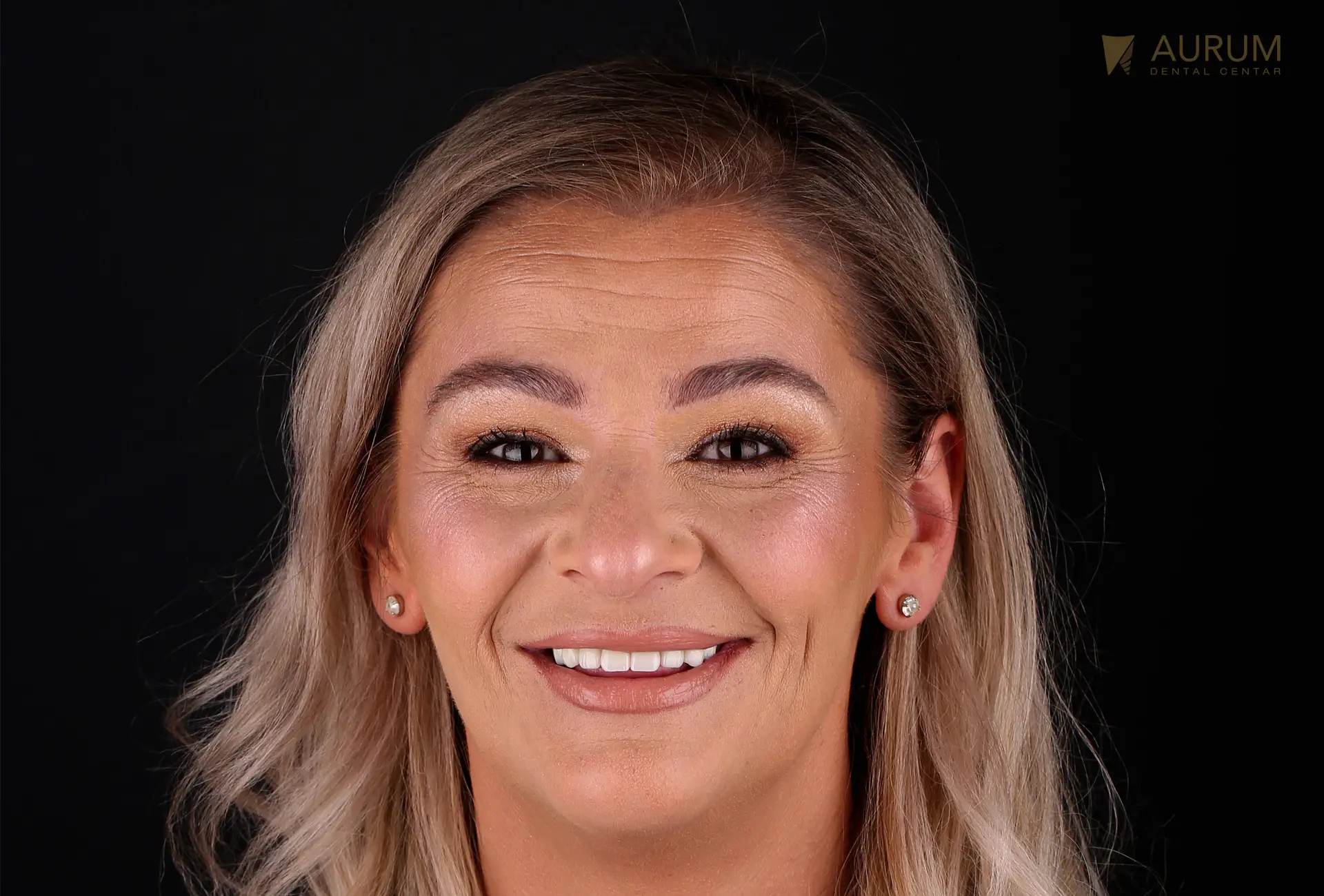 Pacijent u Aurum Dental Centru sa urađenim implantatima i krunama