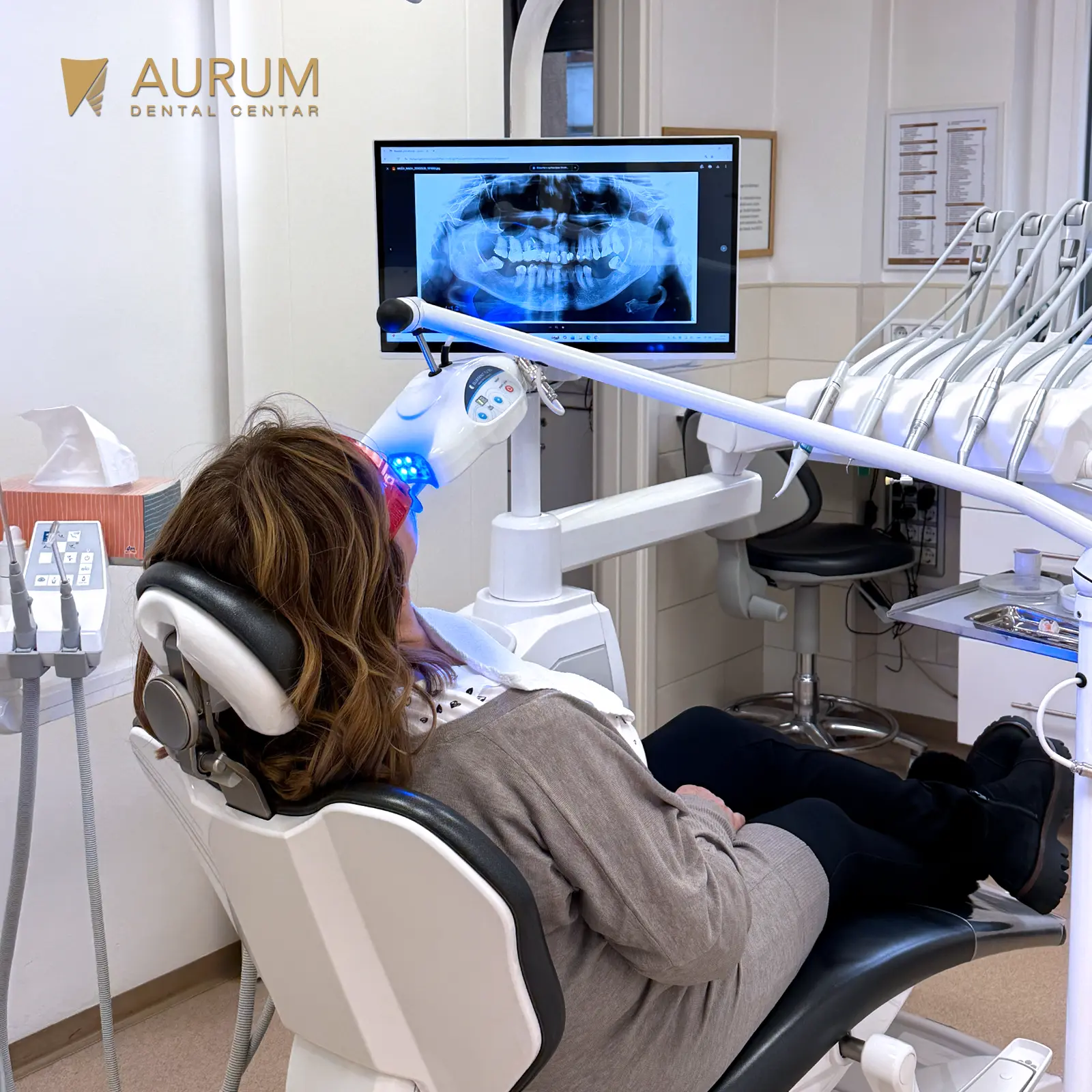 Profesionalno izbjeljivanje zuba u Banja Luci: Otkrijte moć Bluedent 12BL tehnologije